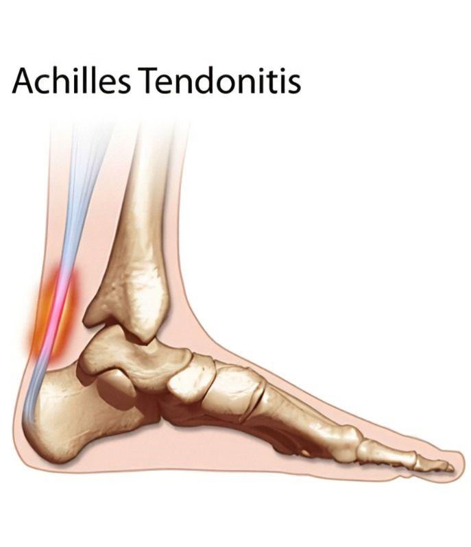 Aşil Tendonu 1
