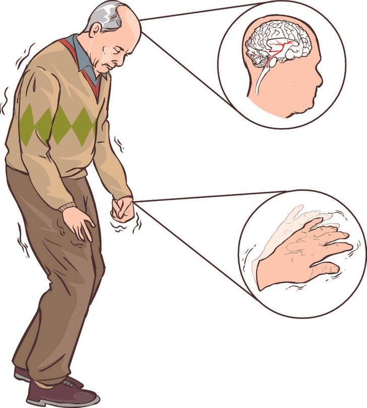 Parkinson Yeni Görsel